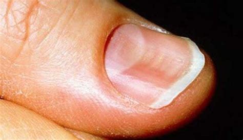 Curved or Spoon-Shaped Toenails